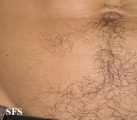 alopecia areata
