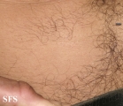 alopecia areata