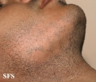 alopecia areata