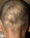 alopecia areata