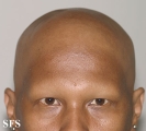 alopecia areata