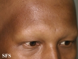 alopecia areata