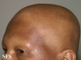 alopecia areata