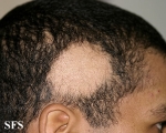 alopecia areata