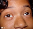 alopecia areata