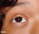 alopecia areata