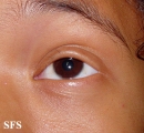 alopecia areata
