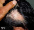 alopecia areata