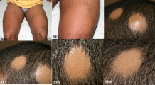 alopecia areata