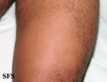 alopecia areata