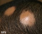 alopecia areata