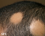 alopecia areata