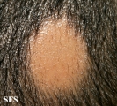 alopecia areata