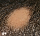 alopecia areata