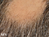 alopecia areata