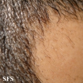 alopecia areata