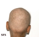 alopecia areata
