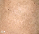 alopecia areata