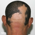alopecia areata
