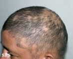 alopecia areata