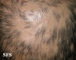 alopecia areata