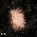 alopecia areata