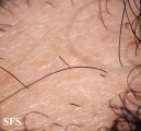 alopecia areata