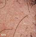 alopecia areata