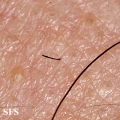 alopecia areata