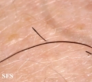 alopecia areata