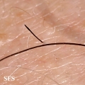 alopecia areata