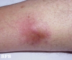 mycobacterial infections-atypical