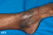 acroangiodermatitis