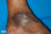 acroangiodermatitis