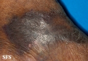 acroangiodermatitis