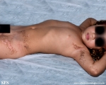 inflammatory linear verrucous epidermal naevi