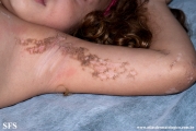 inflammatory linear verrucous epidermal naevi