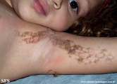 inflammatory linear verrucous epidermal naevi