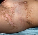 inflammatory linear verrucous epidermal naevi