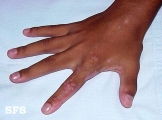 inflammatory linear verrucous epidermal naevi