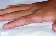 inflammatory linear verrucous epidermal naevi