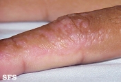 inflammatory linear verrucous epidermal naevi
