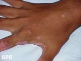 inflammatory linear verrucous epidermal naevi