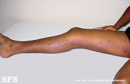 inflammatory linear verrucous epidermal naevi
