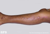 inflammatory linear verrucous epidermal naevi