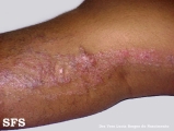 inflammatory linear verrucous epidermal naevi
