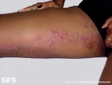 inflammatory linear verrucous epidermal naevi