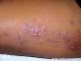 inflammatory linear verrucous epidermal naevi