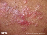 inflammatory linear verrucous epidermal naevi