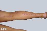 inflammatory linear verrucous epidermal naevi